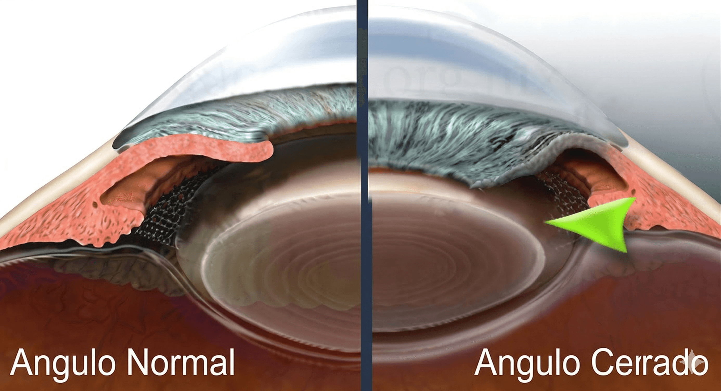 Glaucoma de ángulo cerrado